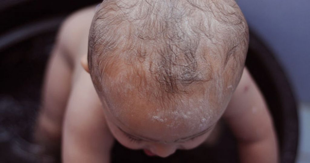 Cara-Cara Untuk Hilangkan Kerak Pada Kepala Bayi